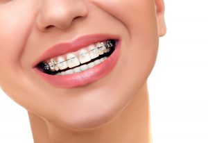 aparelhos-ortodonticos-curitiba