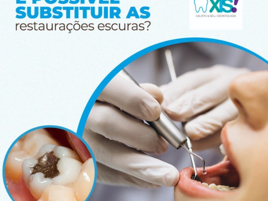 É possível substituir as restaurações escuras?